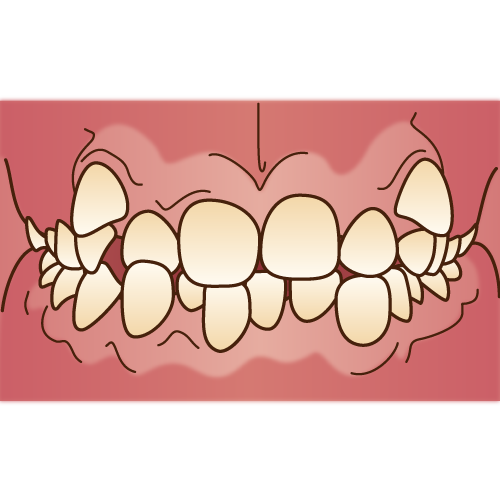 歯並びが悪いとどうなるか？