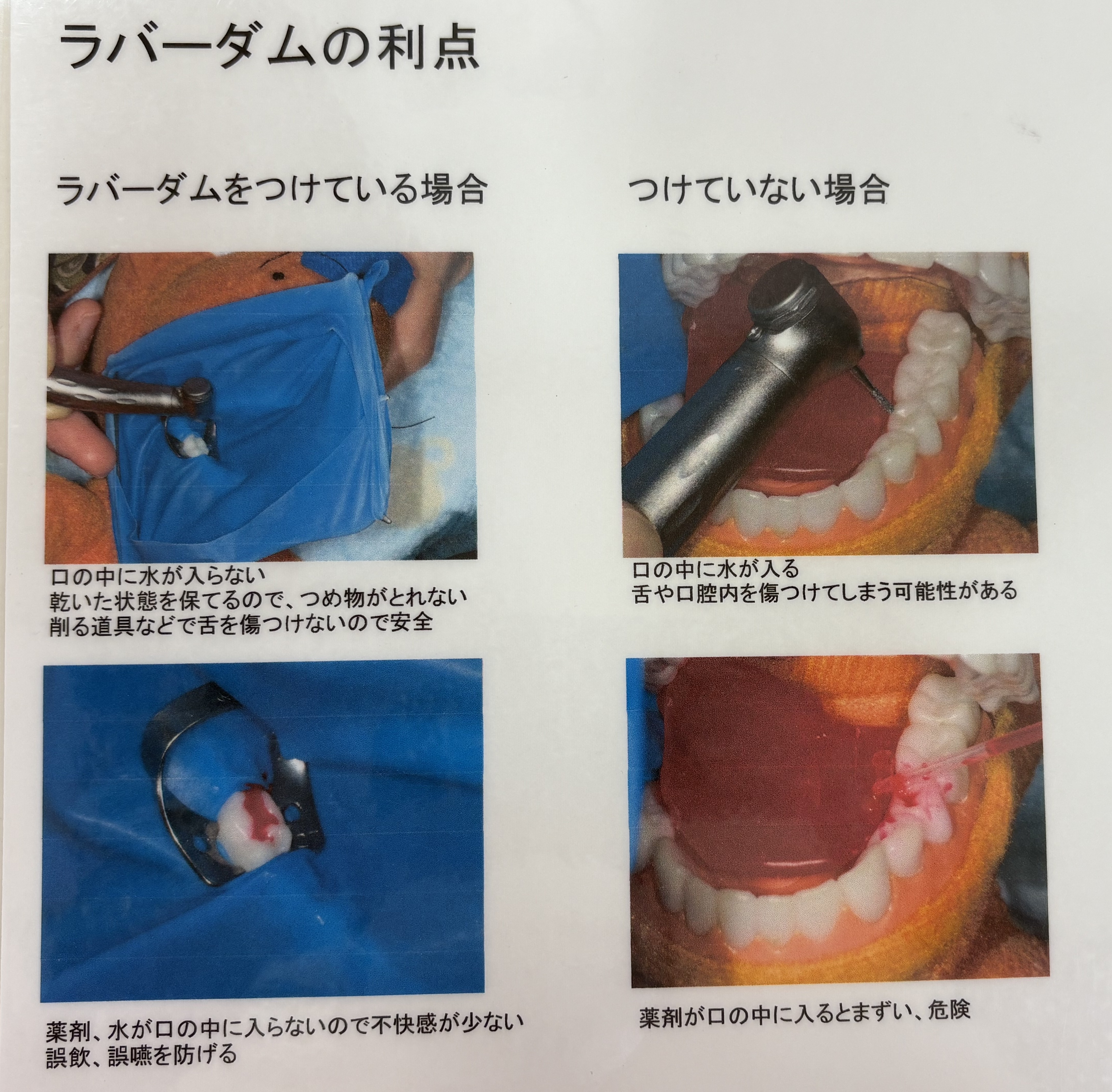 ラバーダムあり
