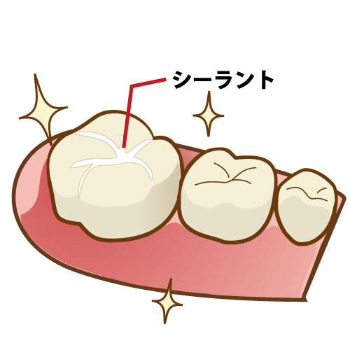 シーラントを使用した虫歯予防